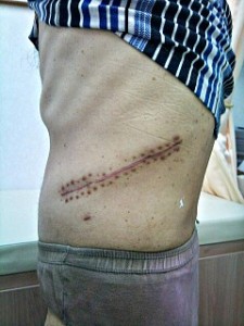 Chan Yee Kwong Partial nephrectomy for web