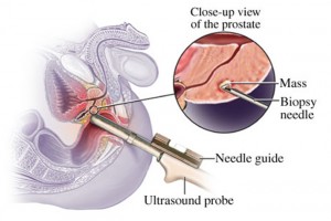 prostate-biopsy