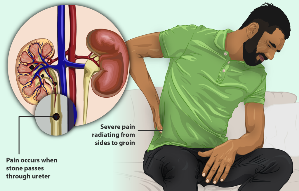 How painful are kidney stones deals